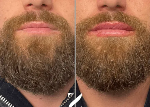 טיפולי אסתטיקה לגברים שפתיים חומצה היאלורונית