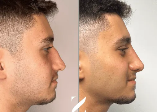 טיפולי עיצוב אף לגברים עם חומצה היאלורונית