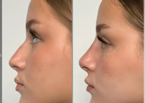 עיצוב אף חומצה היאלורונית ד"ר זרח זד מדיקל קלאב