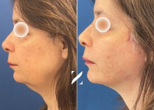 ניתוח מתיחת פנים וצוואר (Facelift)