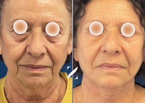 ניתוח מתיחת פנים וצוואר (Facelift)