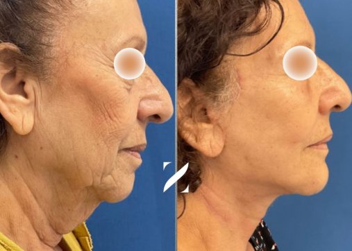 ניתוח מתיחת פנים וצוואר (Facelift)