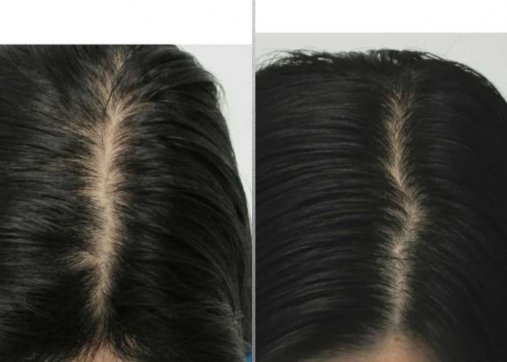 Hair PRP