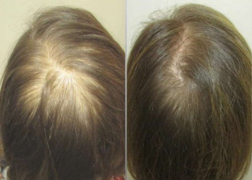Hair PRP
