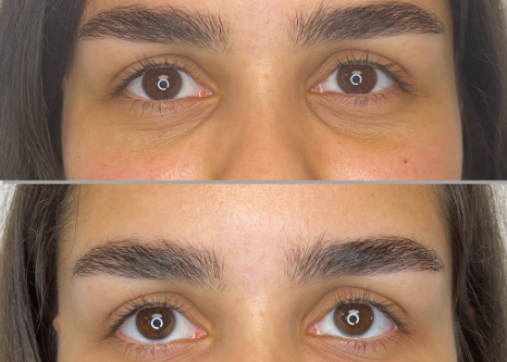 Eye socket filling