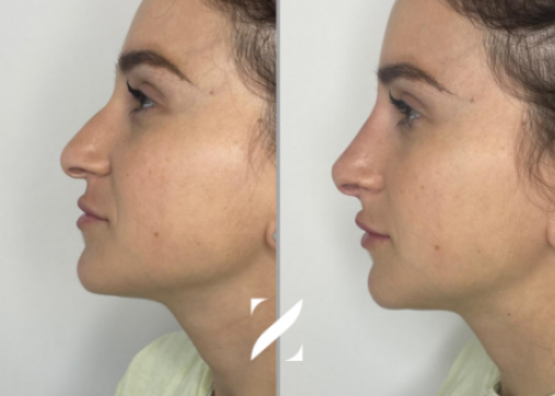 Nose shaping without surgery