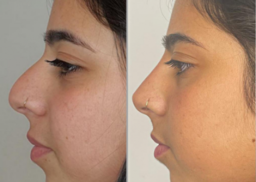 Nose shaping without surgery