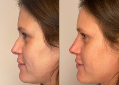 Nose shaping without surgery