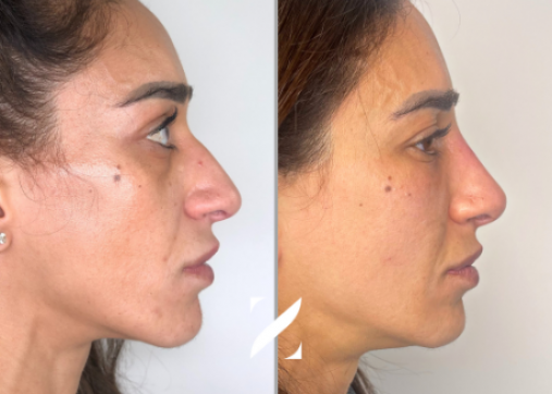 Nose shaping without surgery