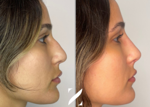 Nose shaping without surgery