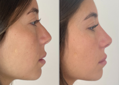Nose shaping without surgery