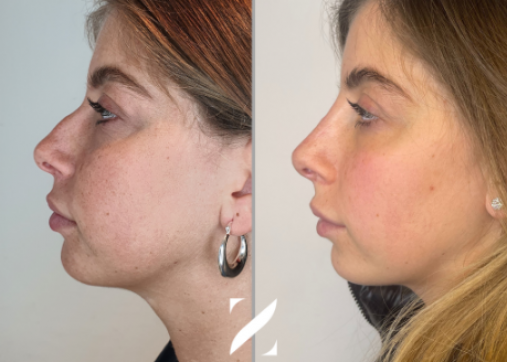 Nose shaping without surgery