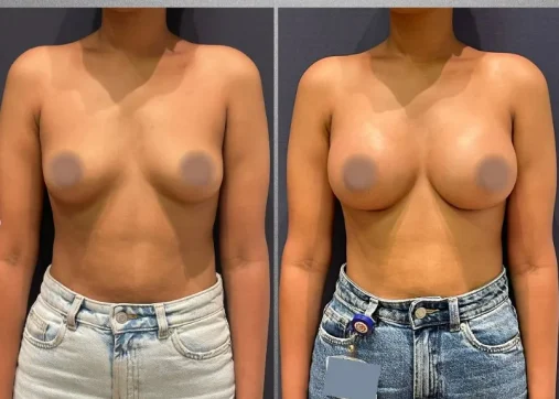 Breast Augmentation | Breast Augmentation and Lift