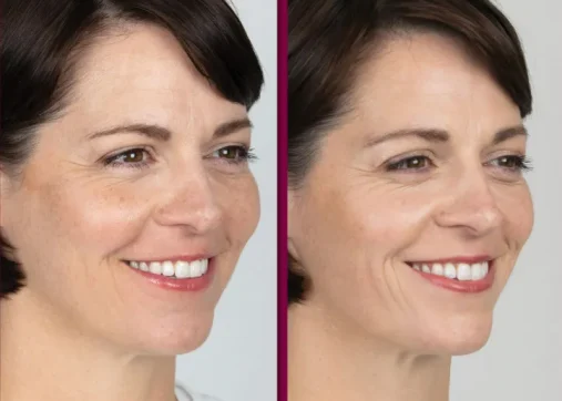 Sculptra and biostimulators for a natural look
