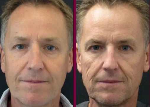 Sculptra and biostimulators for a natural look