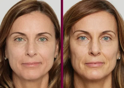 Sculptra and biostimulators for a natural look