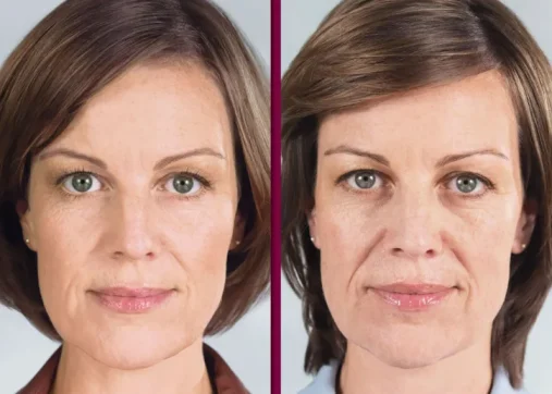 Sculptra and biostimulators for a natural look