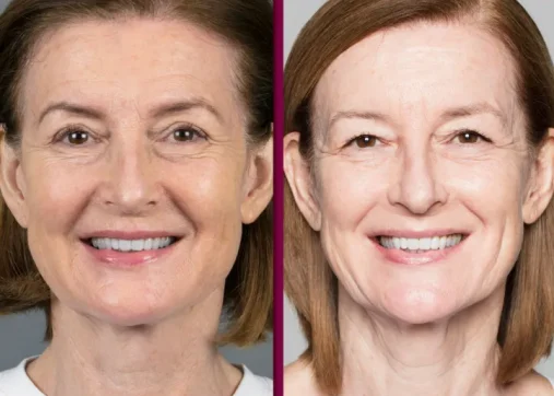 Sculptra and biostimulators for a natural look