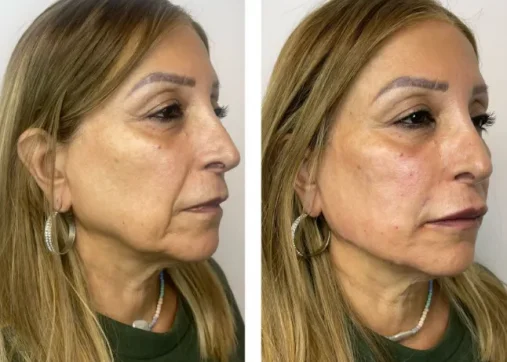 Facial sculpting without surgery