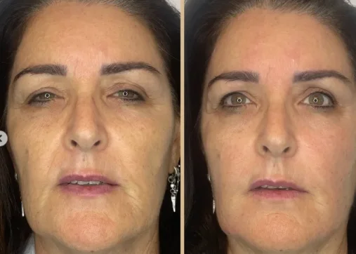 Facial sculpting without surgery