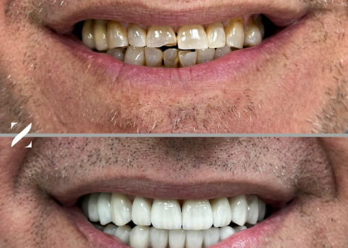 Dental veneers