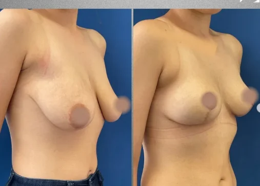 Breast Augmentation | Breast Augmentation and Lift