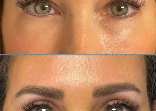 Upper or lower eyelids
