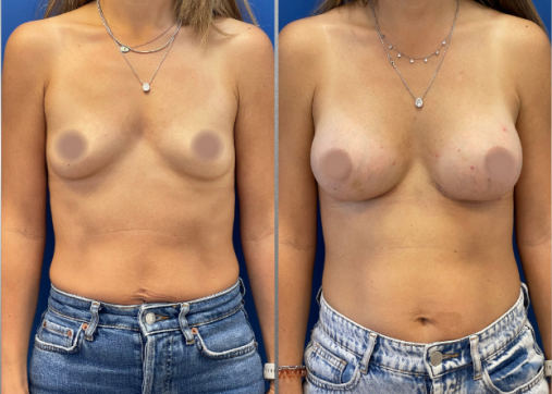 Breast Augmentation | Breast Augmentation and Lift