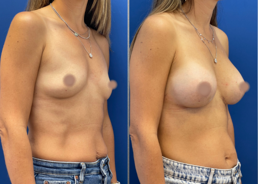 Breast Augmentation | Breast Augmentation and Lift