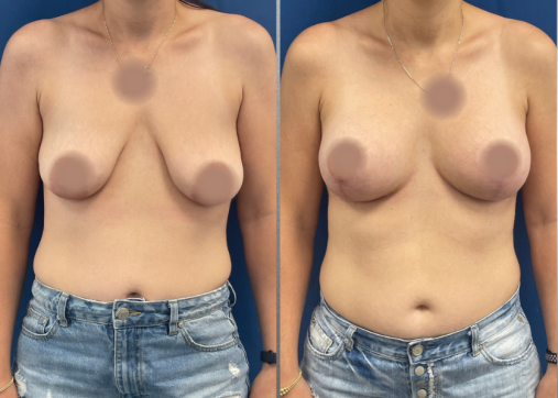 Breast Augmentation | Breast Augmentation and Lift