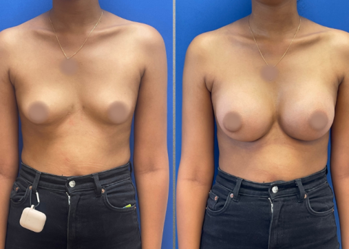 Breast Augmentation | Breast Augmentation and Lift