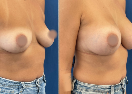Breast Augmentation | Breast Augmentation and Lift