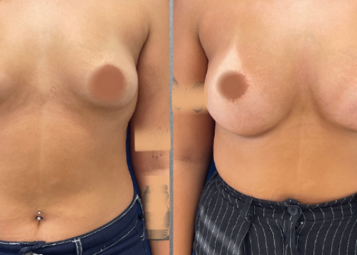 Breast Augmentation | Breast Augmentation and Lift