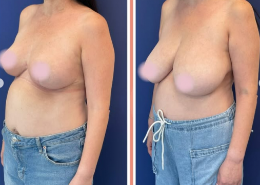 Breast reduction and lift