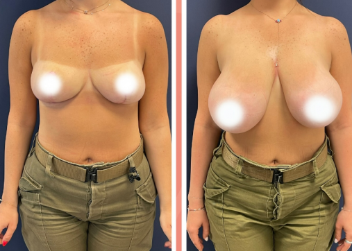 Breast reduction and lift