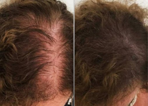 iPRF Hair