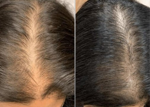 iPRF Hair