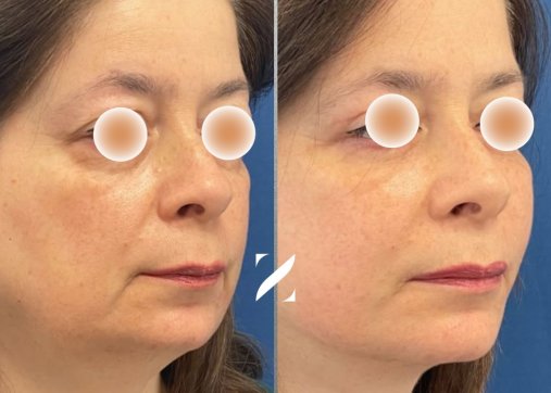 ניתוח מתיחת פנים וצוואר (Facelift)