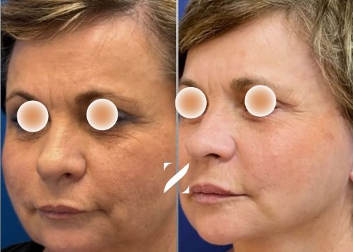 Mini Facelift