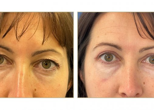 Upper or lower eyelids