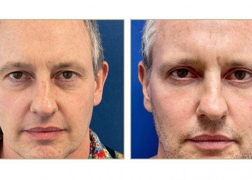 Upper or lower eyelids