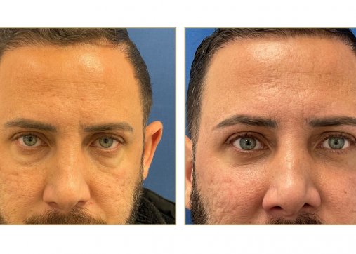 Upper or lower eyelids