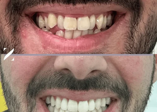 Clear teeth alignment