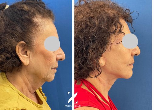 ניתוח מתיחת פנים וצוואר בשיטת דיפ פליין